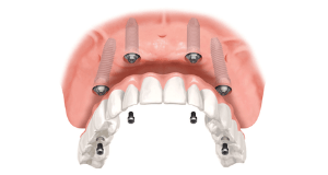 Dantură fixă pe 4 implanturi standard