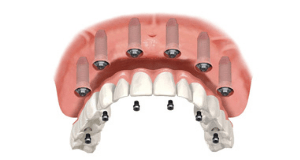 Dantură fixă pe 6 implanturi standard