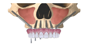 Dantură fixă pe implanturi convenționale și 2 implanturi zigomatice