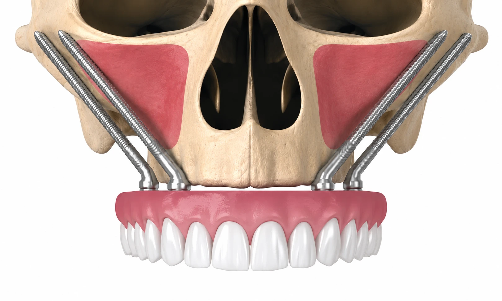 Fixed teeth on 4 zygomatic implants