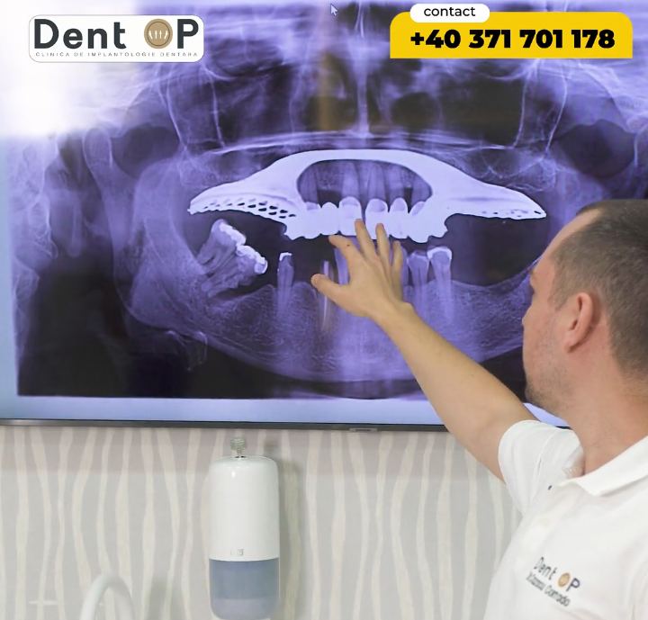Placa mobilă și boala parodontală au condus la multiple complicații pentru pacientul DentOP!